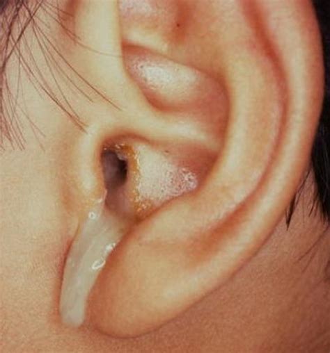 Clear Fluid Ear Discharge: Causes and Treatment Options